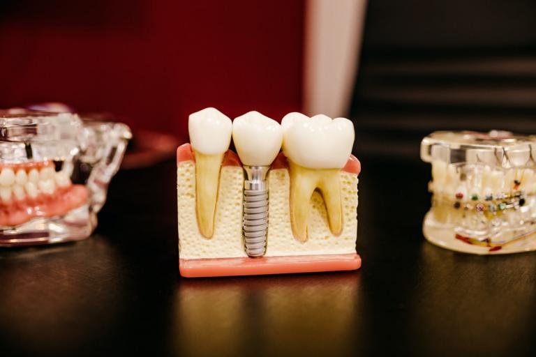 dental implants tarpon springs