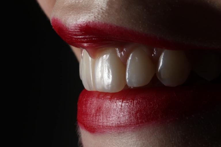dental implants benefit tarpon fl