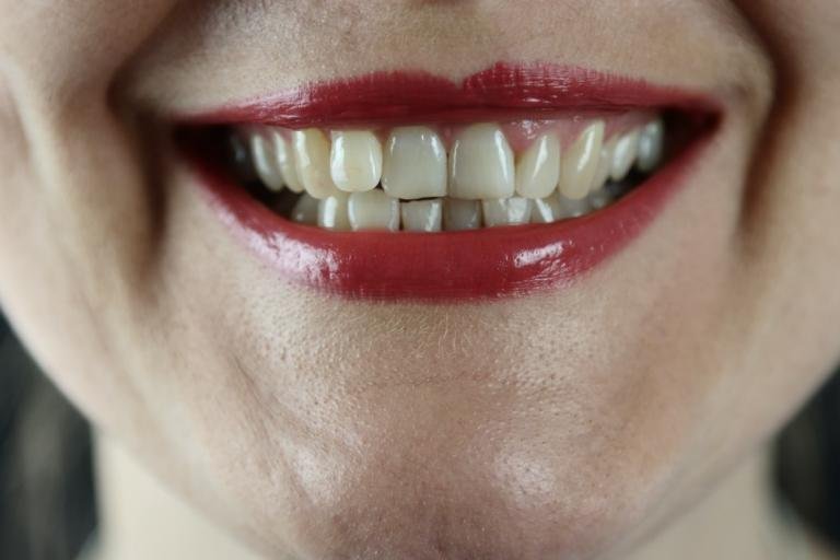teeth whitening tarpon springs fl