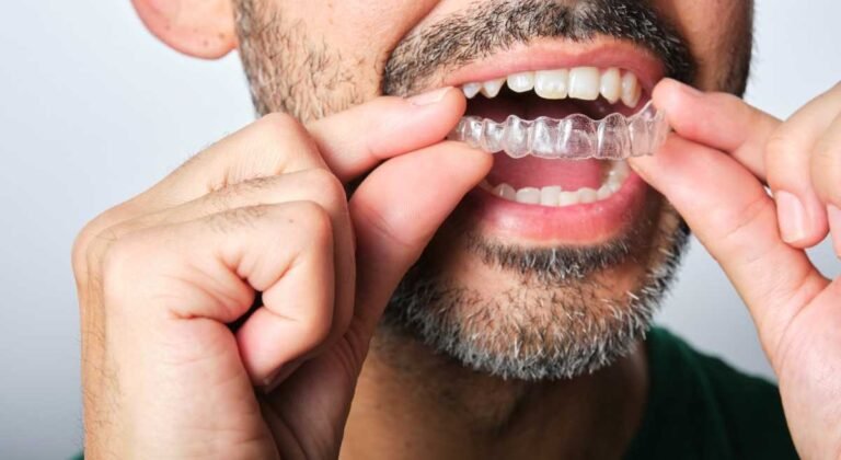 No Adjustments Needed: Living Naturally with Invisalign