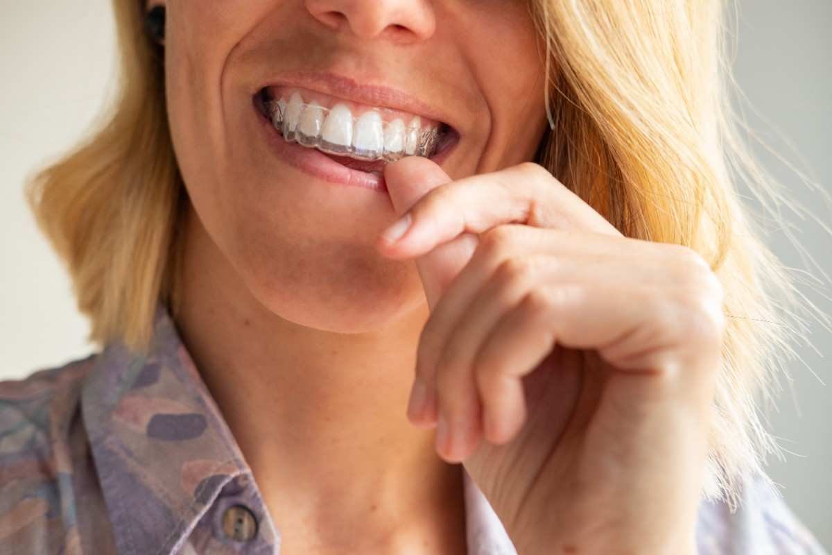 Tips to Reduce Invisalign Pain for Tarpon Springs Patients